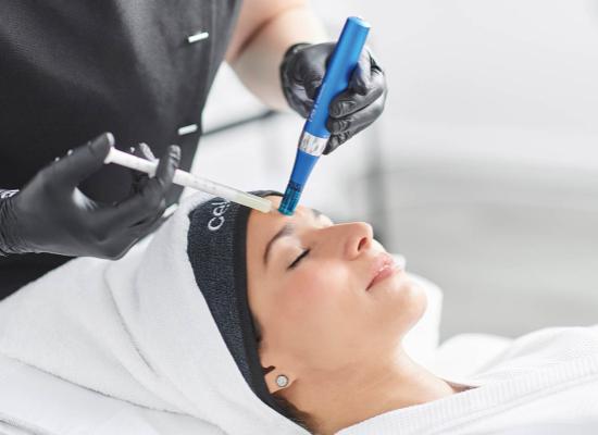 De beste thuisbehandelingen na microneedling in een schoonheidssalon: Je huid verzorgen na de behandeling