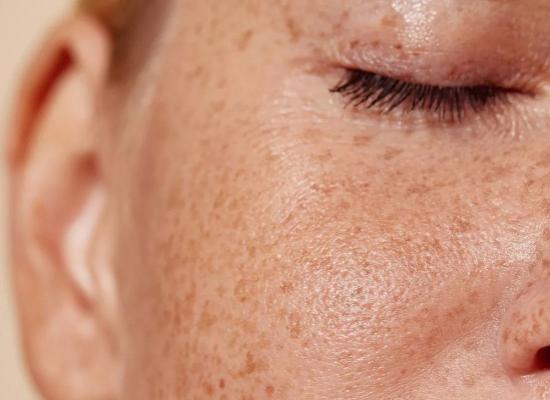 Zijn die vlekjes op uw huid echt pigmentvlekken?