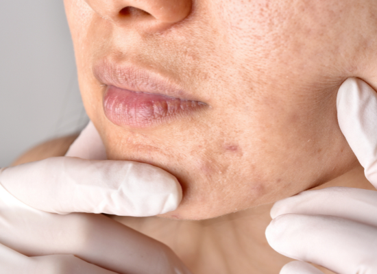 Verstopte poriën (clogged pores) Begrijpen, voorkomen en doeltreffend aanpakken