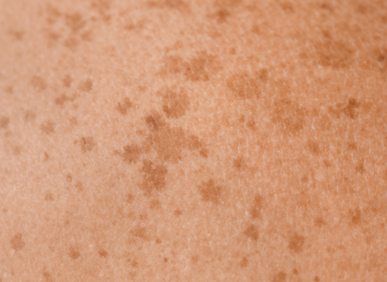 Topisch tranexaminezuur: het anti-vlekken actief dat dermatologen verkiezen (en wat de wetenschap er écht over zegt)